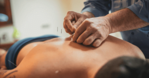 Acupuncture