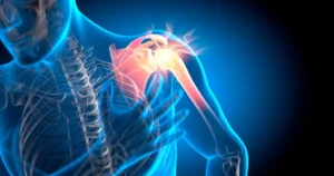 Graphic of skeleton emphasizing shoulder pain